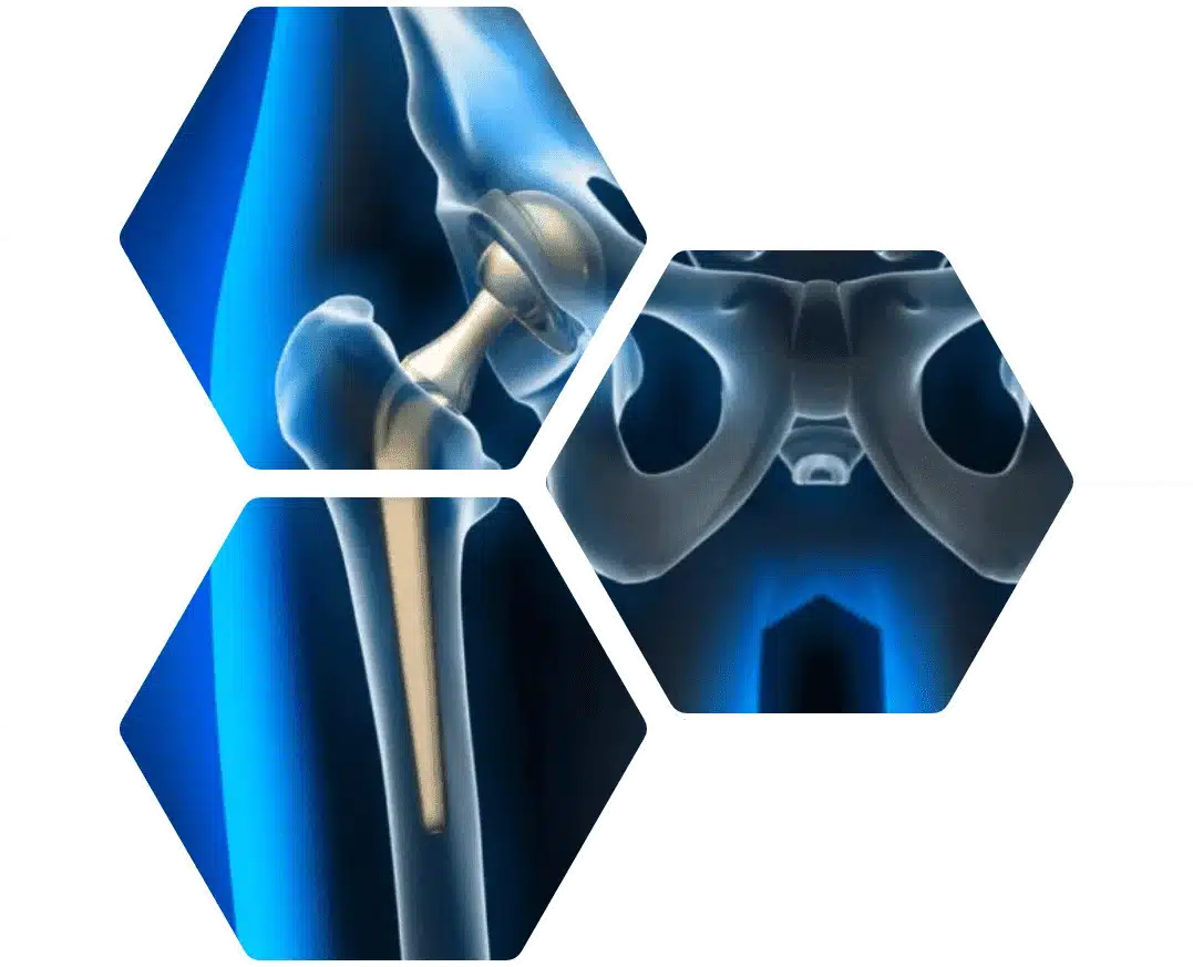 Best Joint Replacement/Hip Repalcement  Surgeon in Jaipur	