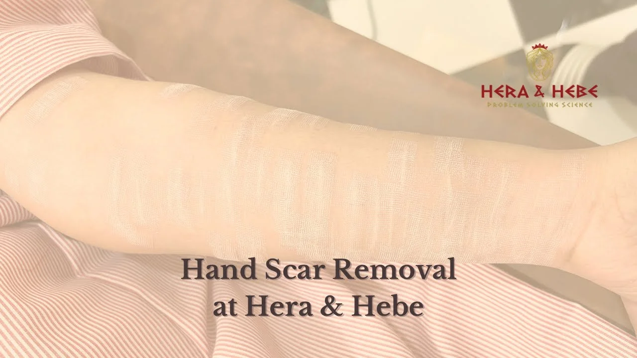 hand scar removel