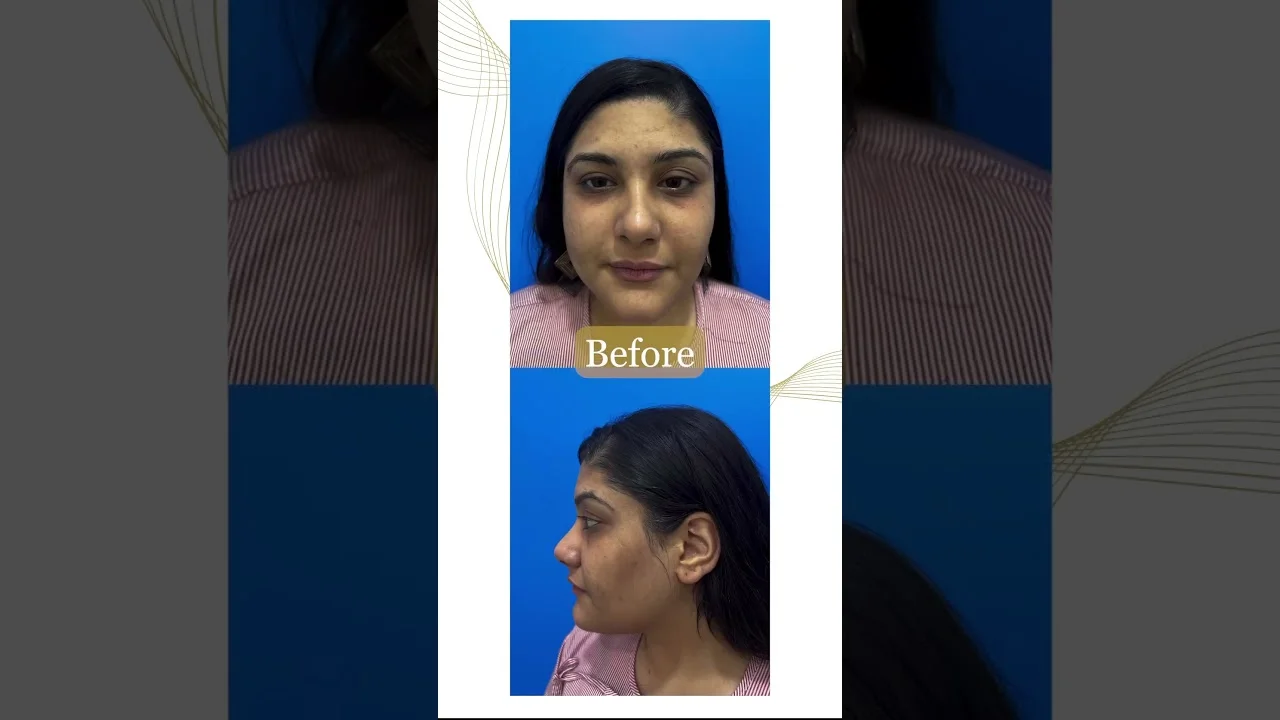 rhinoplasty treatment