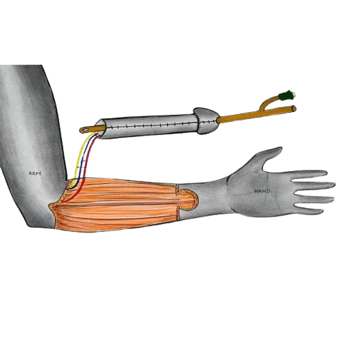 penile reconstruction