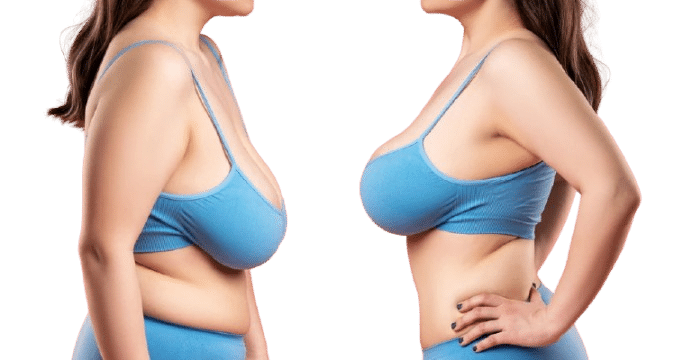 Breast Reduction in Jaipur