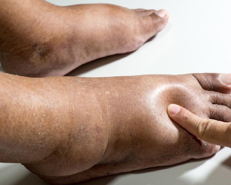 lymphedema-surgery