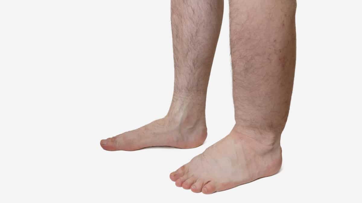 lymphedema surgery