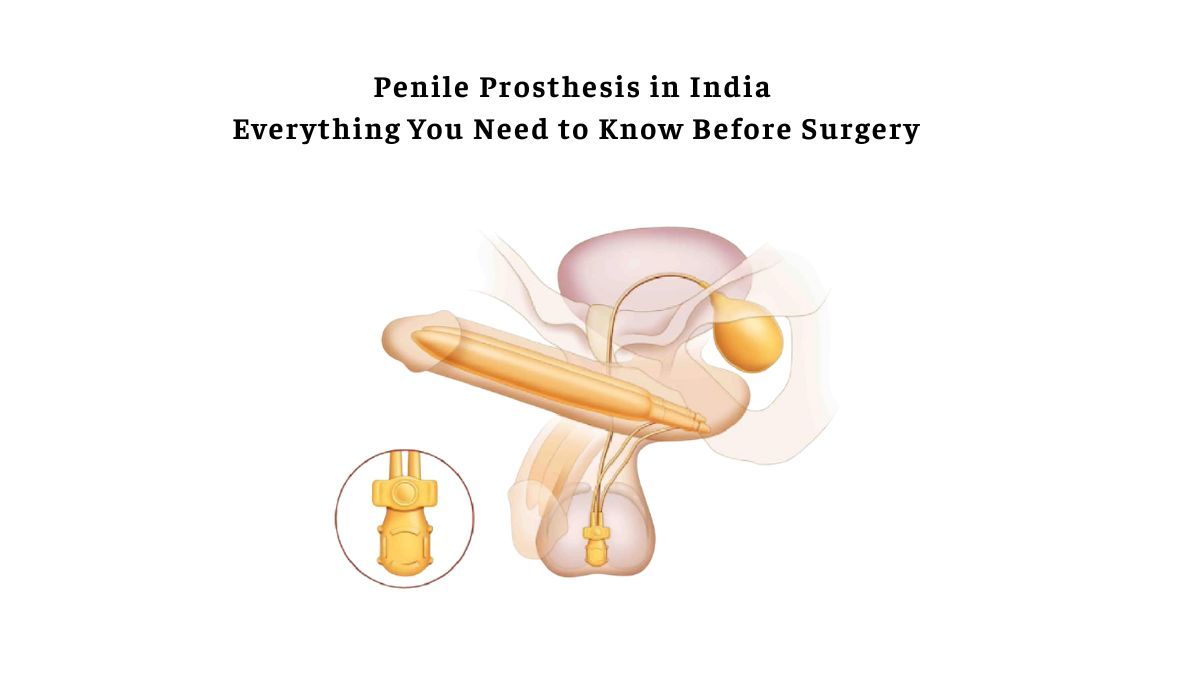 Penile Prosthesis in India: Everything You Need to Know Before Surgery