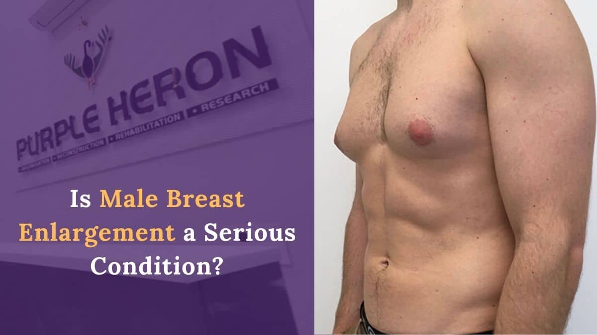 Is Male Breast Enlargement a Serious Condition?