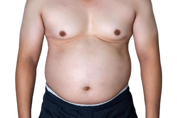 gynecomastia