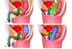 penile-skin-inversion-vaginoplasty