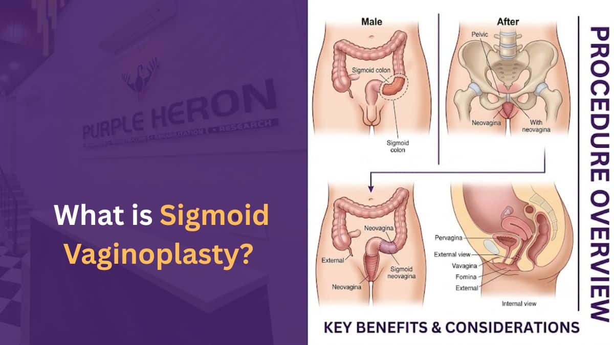 What Is Sigmoid Vaginoplasty?